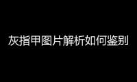 灰指甲圖片解析如何鑒別及治療灰指甲