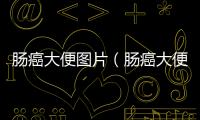 腸癌大便圖片（腸癌大便凹槽的圖片）