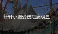 軒軒小腿受傷疤痕明顯 不怕痛開(kāi)心比手勢(shì)【娛樂(lè)新聞】風(fēng)尚中國(guó)網(wǎng)